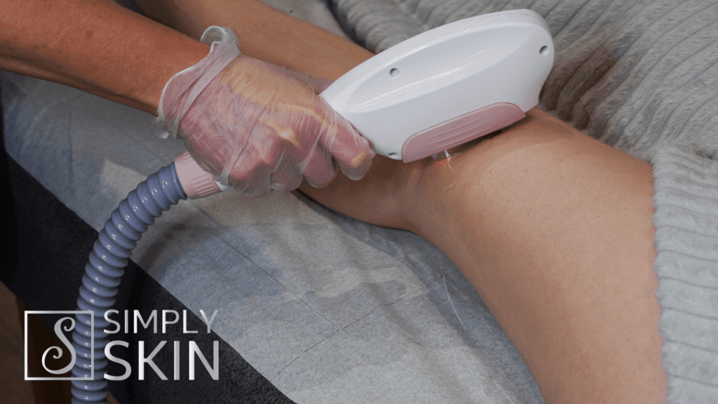 Laser Hair Removal at Simply Skin Kilkenny